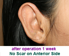 plastic-surgery-prominent-ear 